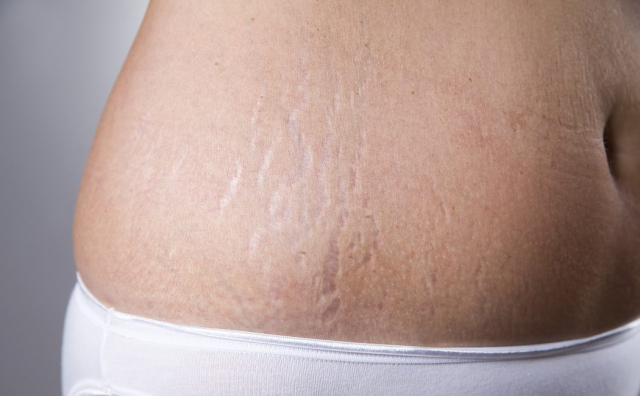 How to avoid stretch marks when we lose weight? 