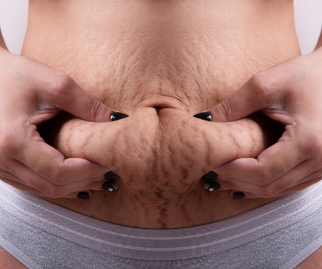 How to avoid stretch marks when losing weight? 