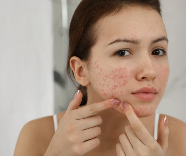 Skin Care - Acne Prevention 